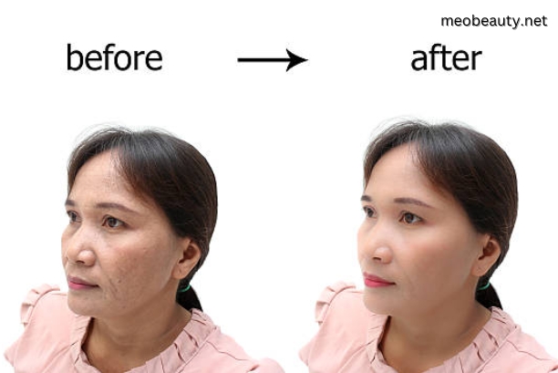 Before and After Obagi Skin Care